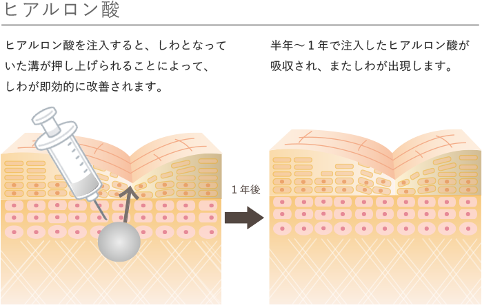 ヒアルロン酸